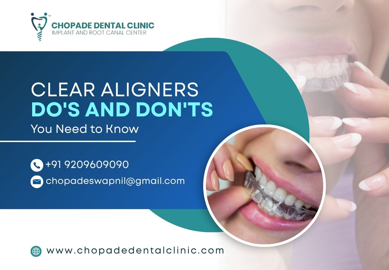 Clear Aligners Do's and Don'ts You Need to Know Clear Aligners Do's and Don'ts You Need to Know