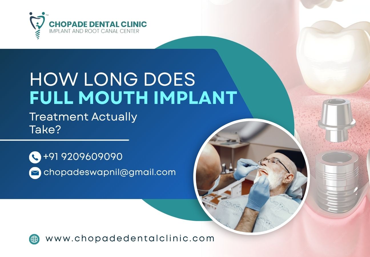 How Long Does Full Mouth Implant Treatment Actually Take? How Long Does Full Mouth Implant Treatment Actually Take?